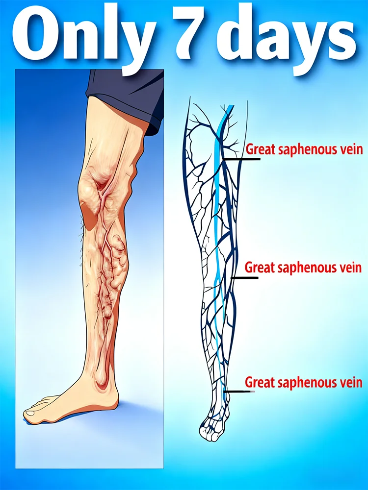 2025 New upgraded laser, remove spider legs and varicose veins in just 7 days