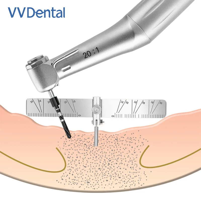 VV Dental Implant Guide Locator Set For Oral Planting Positioning Dentist Guide Ruler Tool