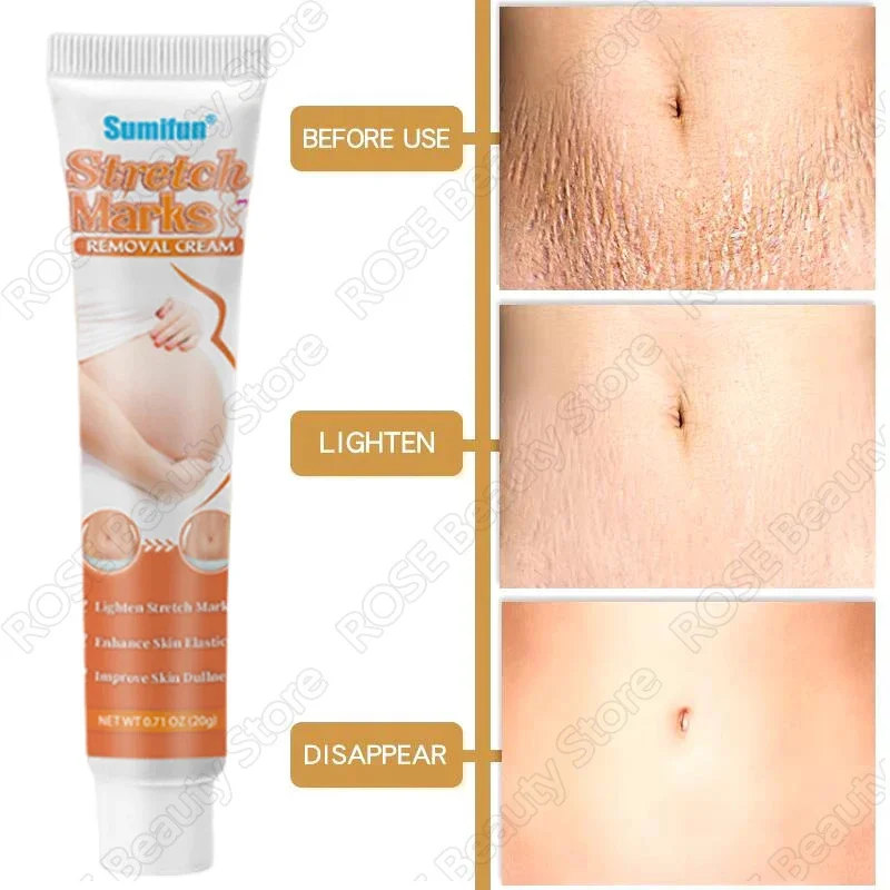 Krim penghilang Stretch mark, Anti kerut Anti Penuaan perawatan kulit kehamilan menghilangkan bekas luka kehamilan perawatan tubuh ketat