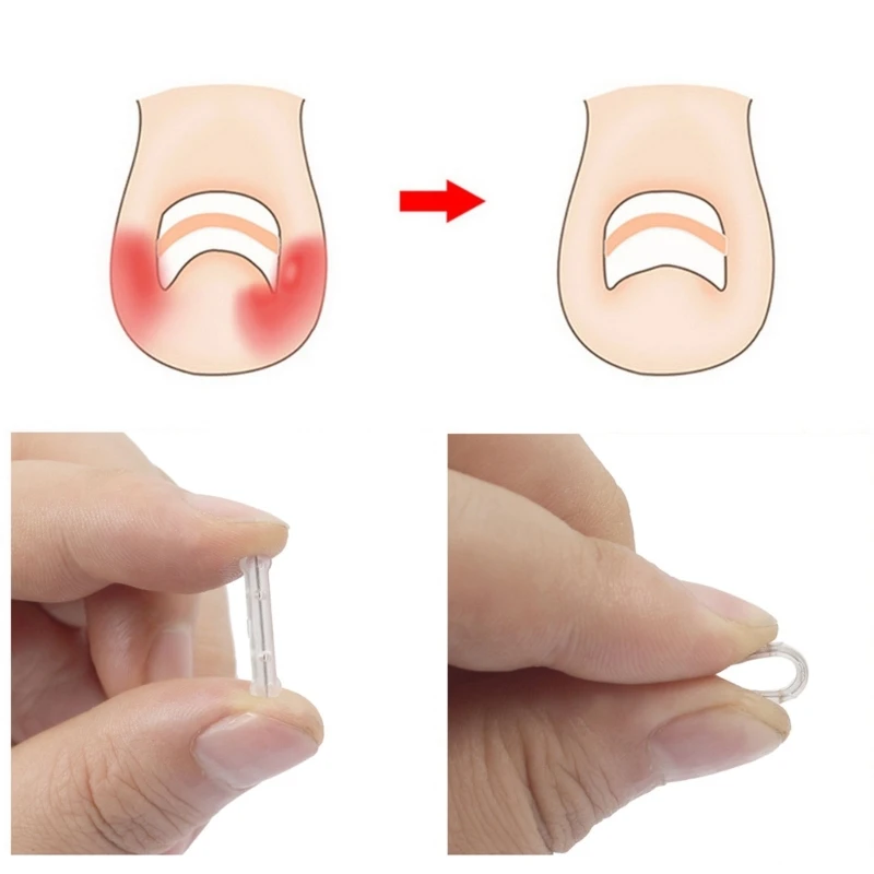 

Ingrown Toe Correction Clip Lifter and Tape Pedicure Tool Toenail Corrector