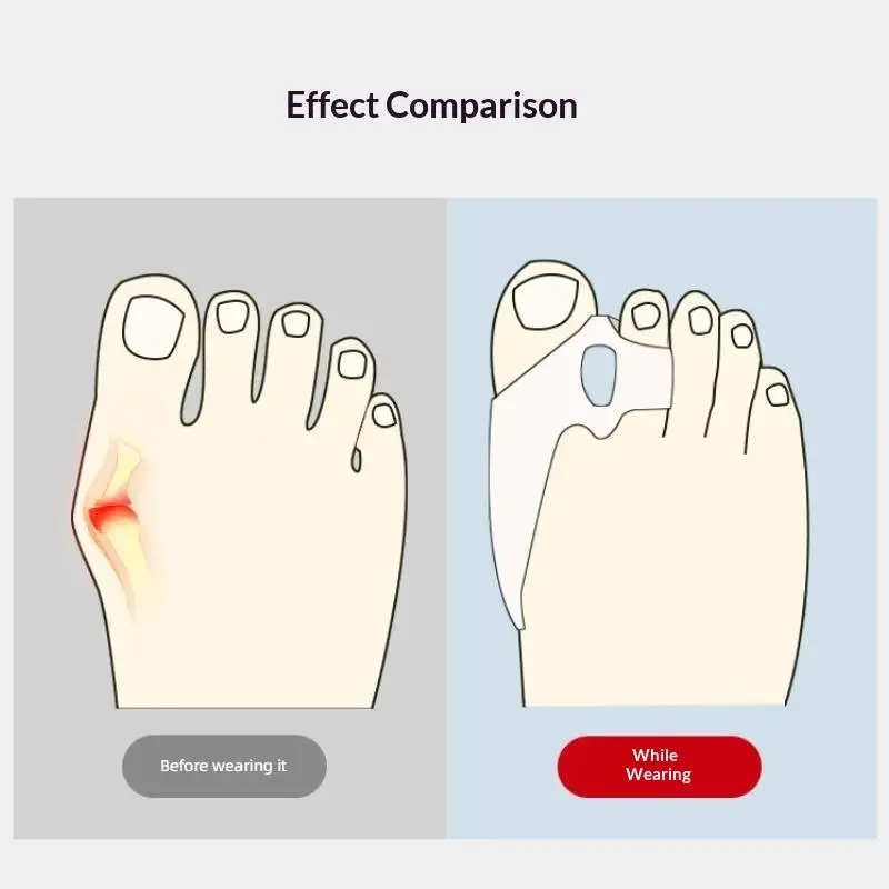 1 Paar weiche Zehenspreizer zur Korrektur von Hallux valgus, Abstandshalter und Polster für Hallux valgus, mit Gel-Schutz, zur Fußpflege. – Detail 4