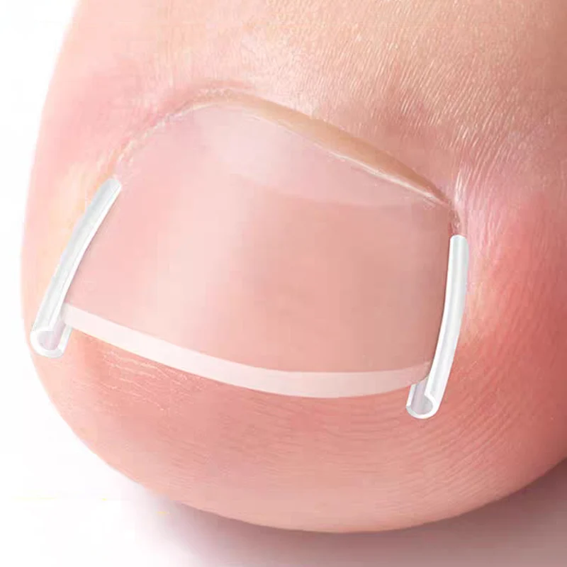 1/10 กล่องยืดหยุ่น C-รูป Tube Pad Treatment ที่มองไม่เห็น Groove Straightening คลิปคุด Toenail Corrector เครื่องมือ Foot Care