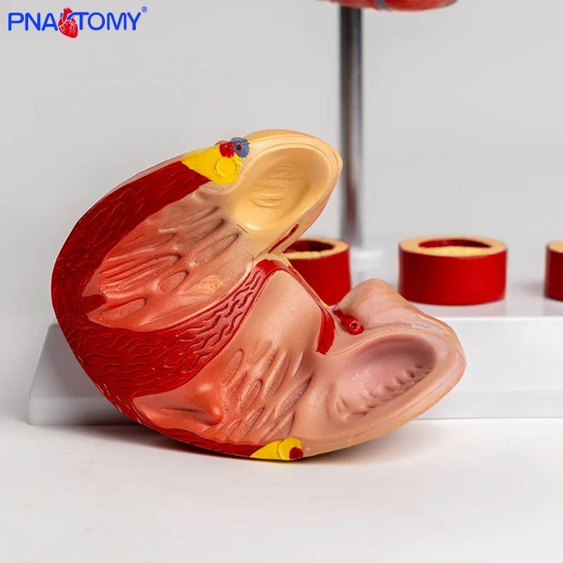 Heart Thrombus Model Anatomically Dissectable Teaching Simulation Natural-sized Heart Thrombus Vascular Model