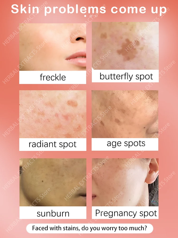 Freckle Removing  Blemish Reduces Chloasma Age Spots Dark Spot Sun Spots Lightening Face Cream Korean Skin Care