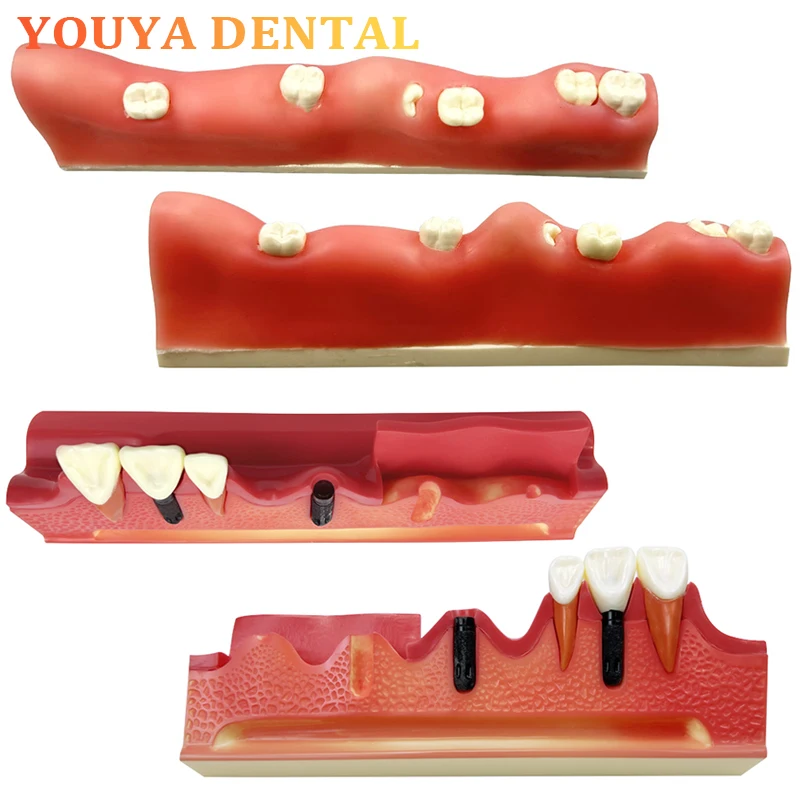 

Модель для демонстрации экстракции сломанного прорезного зуба / Модель для демонстрации этапов установки дентального имплантата, практический стоматологический инструмент