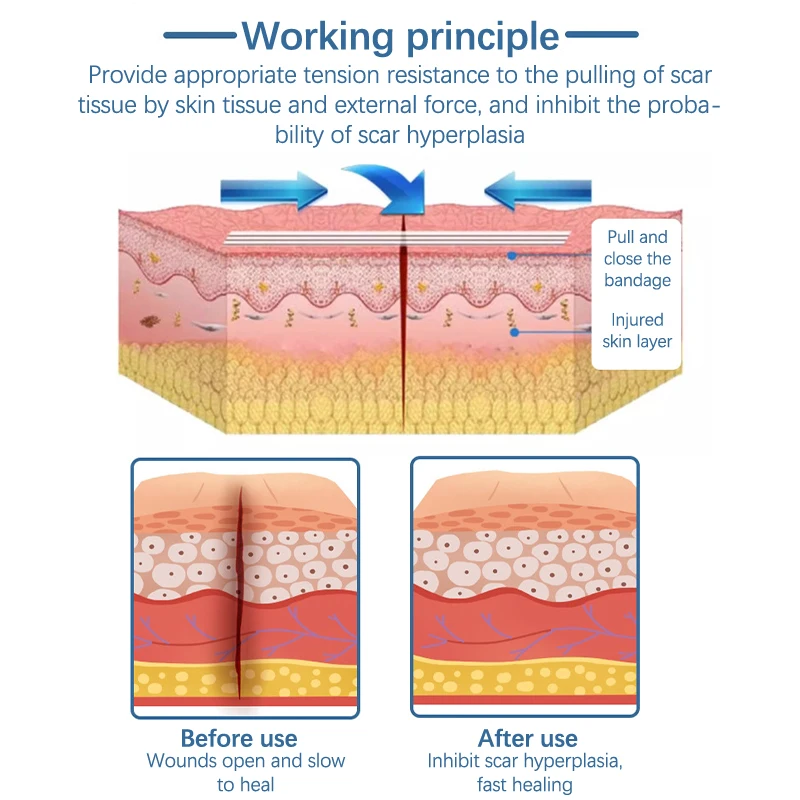 แถบแผลสำหรับซ่อมแซมแผลหลังคลอดแถบผ่าตัดเครื่องสำอางแบบมีกาวเย็บแผลทางการแพทย์2/3/5