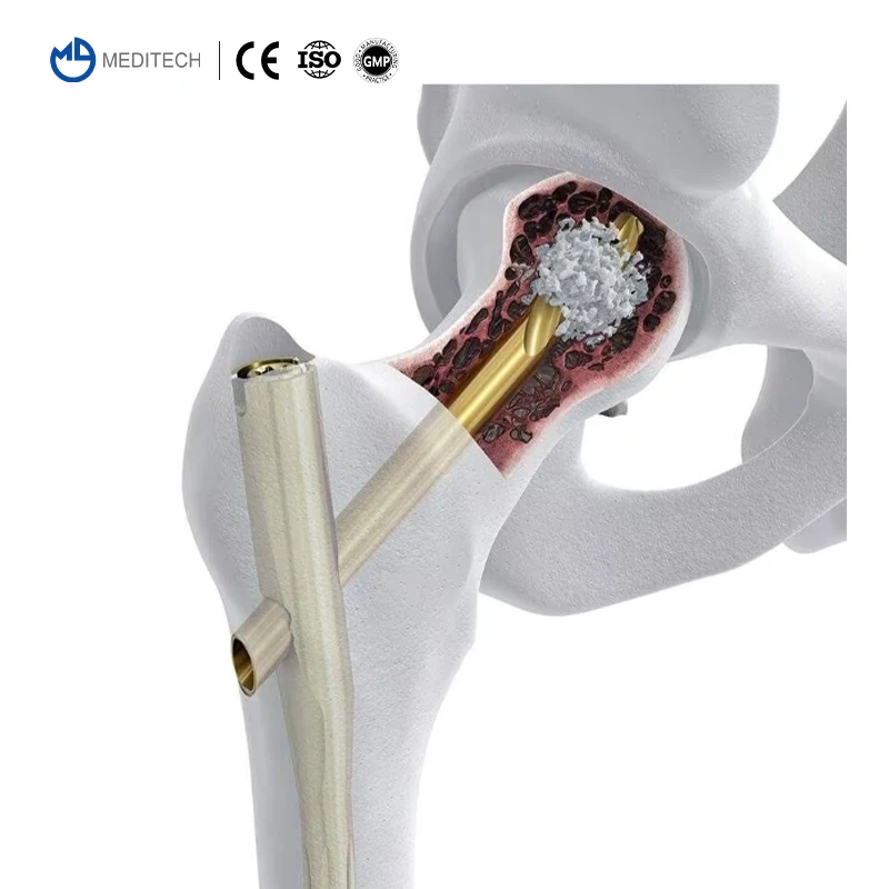 MEDITECH Joint Bone Cement Beste kwaliteit en prijs Chirurgische Bone Cement bone cement injector