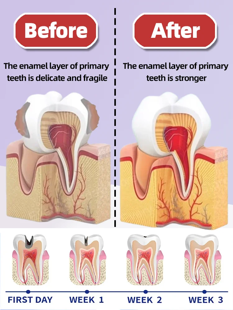 Anti Caries Tooth Decay Healing Cavities