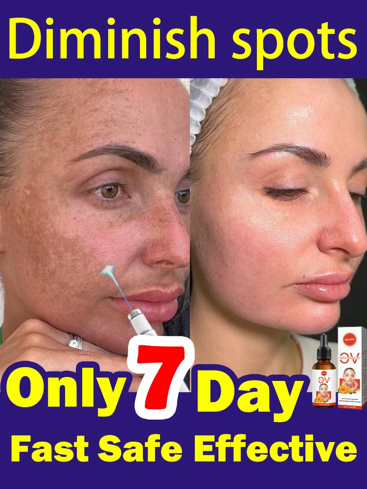 

Крем для удаления темных пятен от веснушек Melasma SunAge Spot