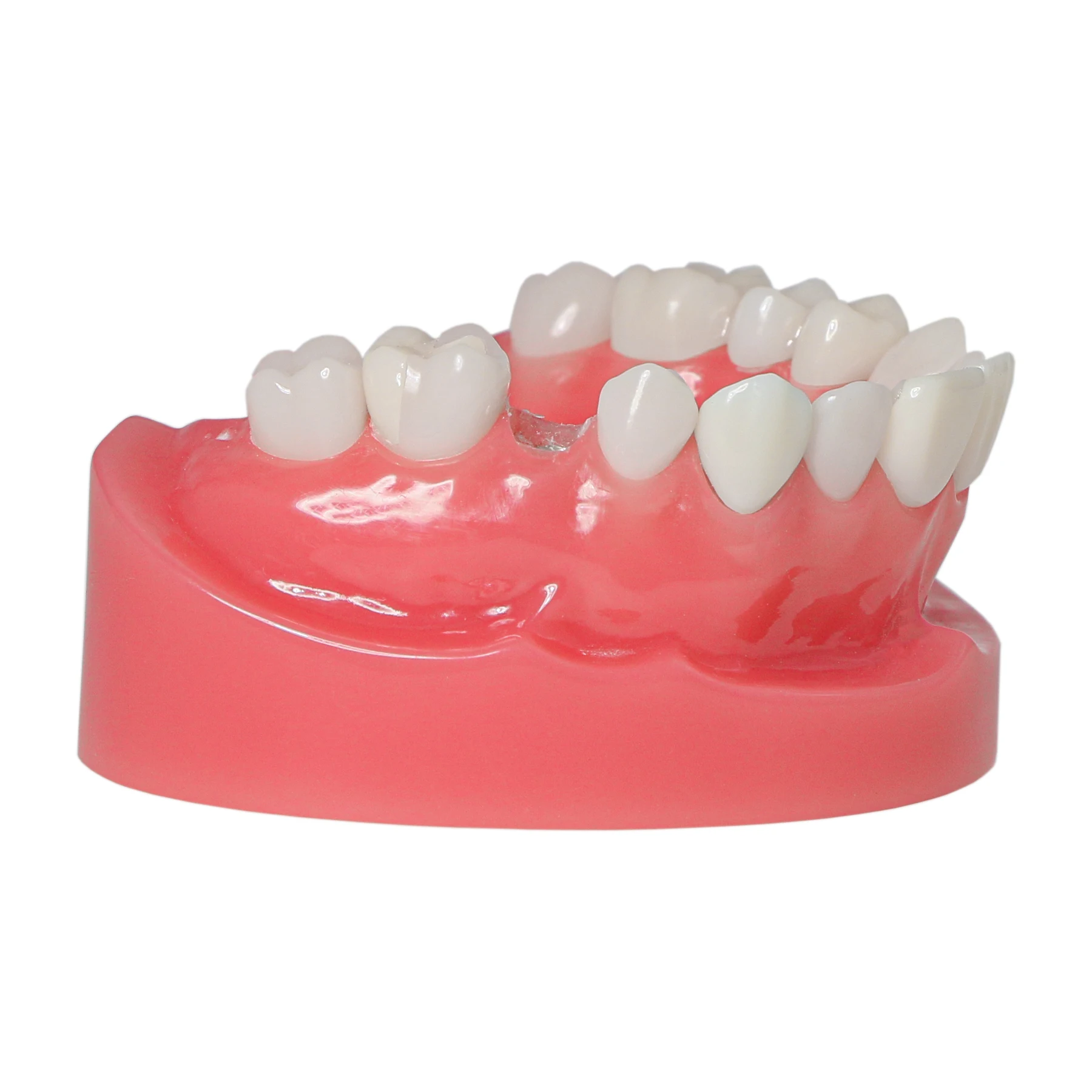 Afbeelding 6: M6024 Dental Post Core Bridge Overdenture Model Implantaatrestauratiemodel