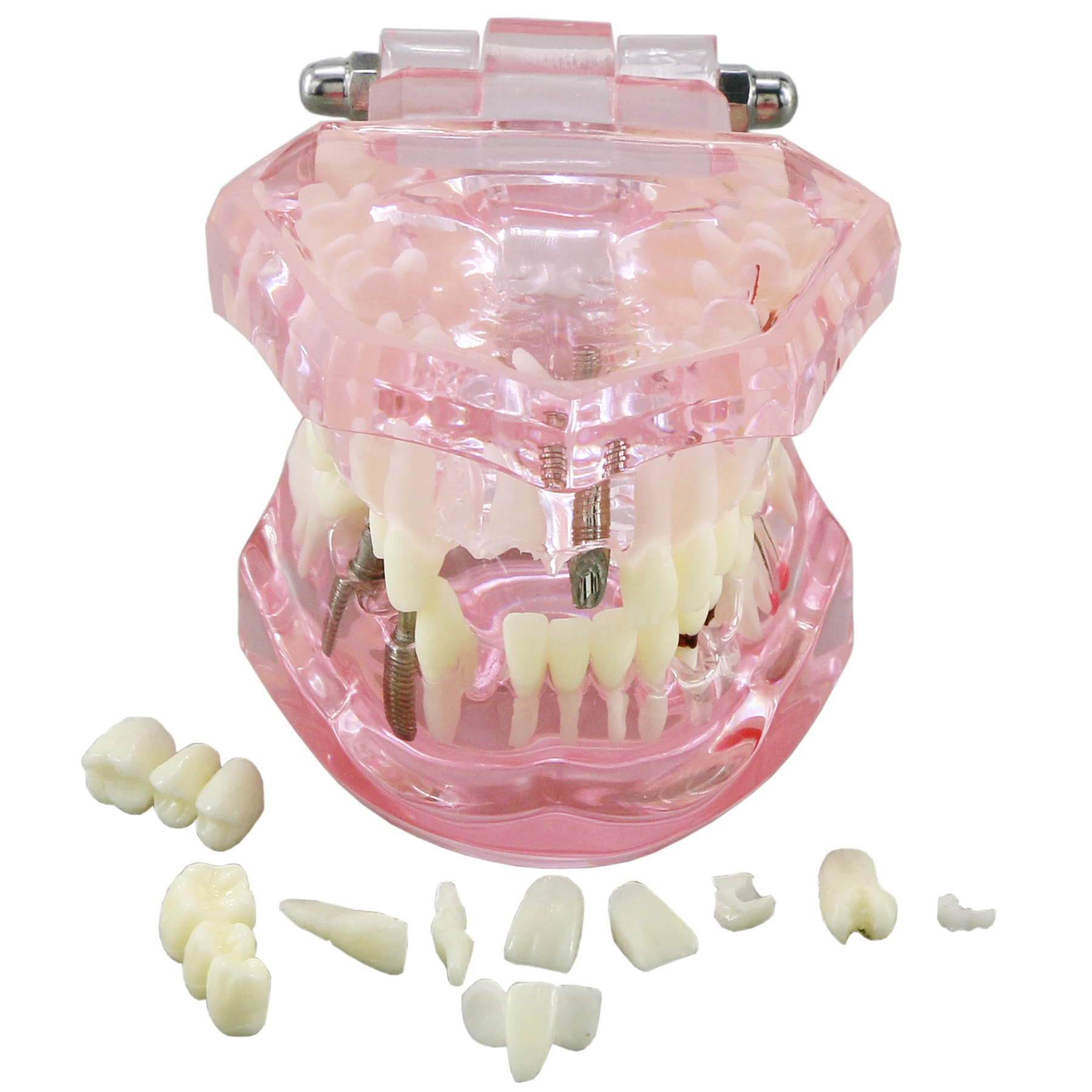 

Classical Transparent Dental Implant Disease Pink Clear Removable Teeth Model for Dentist Student Teaching Desktop Decoration