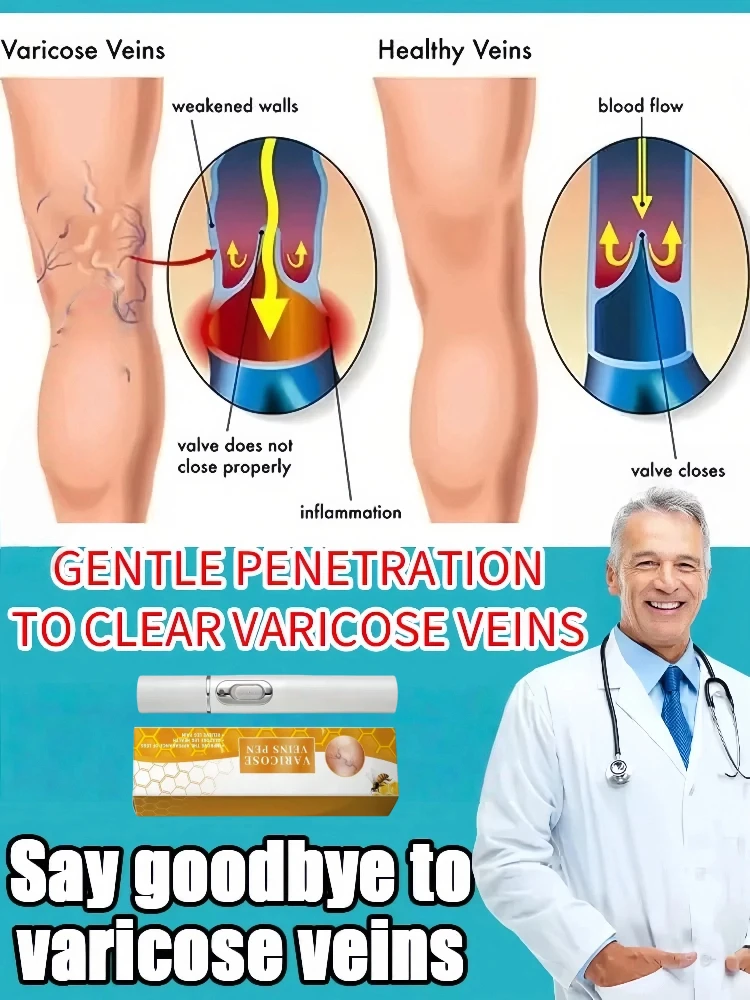 

veins in hand | for Anyone with Sedentary or Standing | ointment for veins | veins exercise