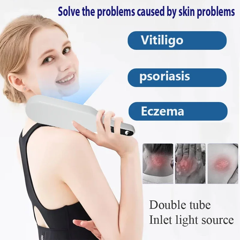 

311nm vitiligo and psoriasis, Uvb lamp double tube for psoriasis treatment, 311 lamp for vitiligo and psoriasis