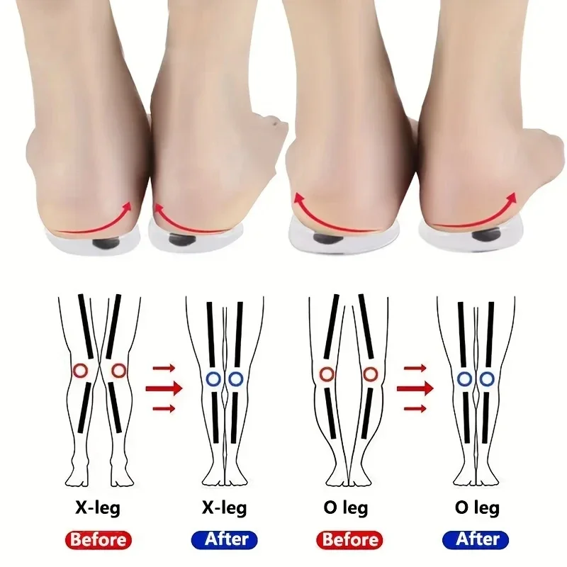 남녀공용 실리콘 젤 신발 깔창, 발 O/X 다리 타입, 외반 교정, 자석 마사지 신발 패드, 1 쌍 