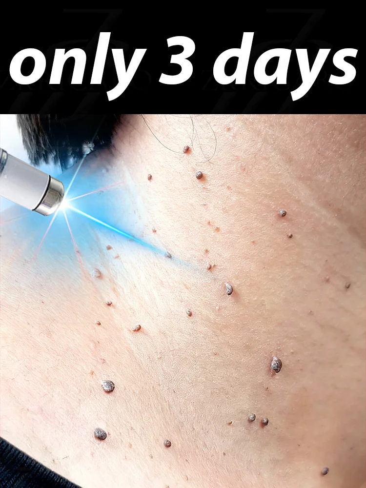 

The first generation of improved wart repair agent wart root fast