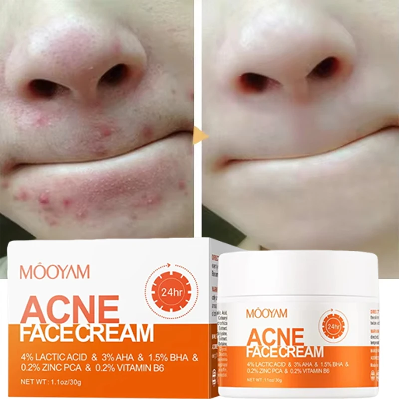 

Herbal Acne Removal Face Cream Anti-Acne Gel Treatment Acne Scar Pore Shrinking Eliminate Large Pores Pimples Whitening Care