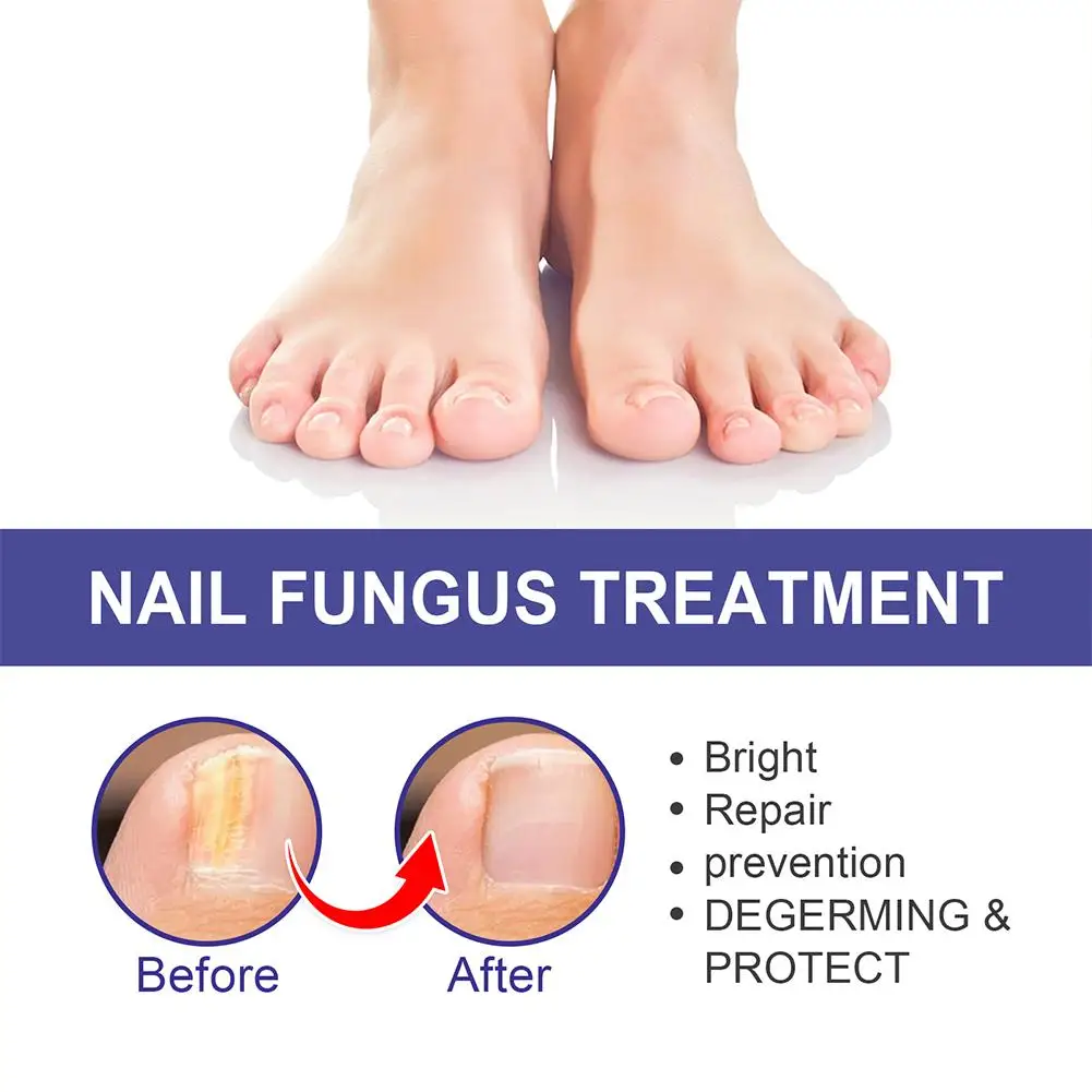 Tratamento do fungo para unhas e unhas dos pés Reparação, Onicomicose Paroníquia, Anti Infecção, Toe remoção de fungos do prego, I7D6