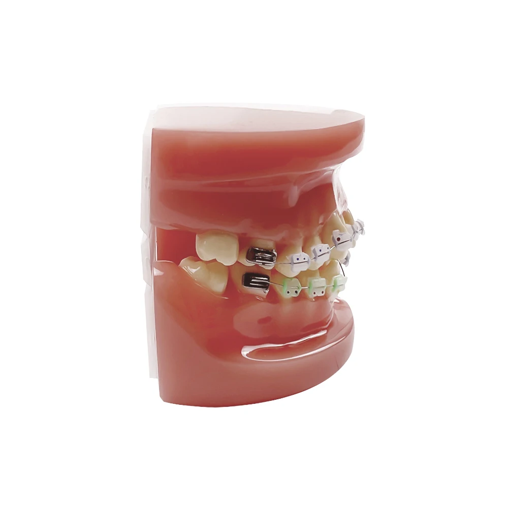 

Dental Orthodontic Model With All Ceramic / Metal Bracket Malocclusion Models Ortho Teeth Model For Teaching Education Studying