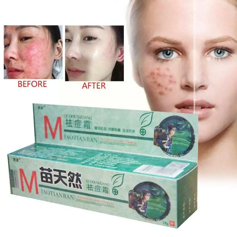 

1 Pc Natural Germicidal Removel Cream Mite Moisturize Ointment Skin Cream Cream Original Remove Acne H6O6