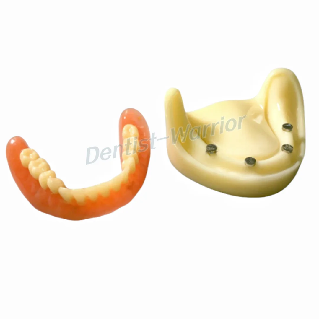 Dental Full Denture Model Overdenture Magnetic Attachment Mandibular Upper Study