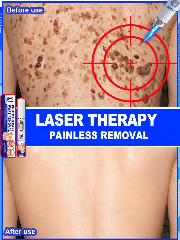 

Christmas Sale: Wart Treatment Tools