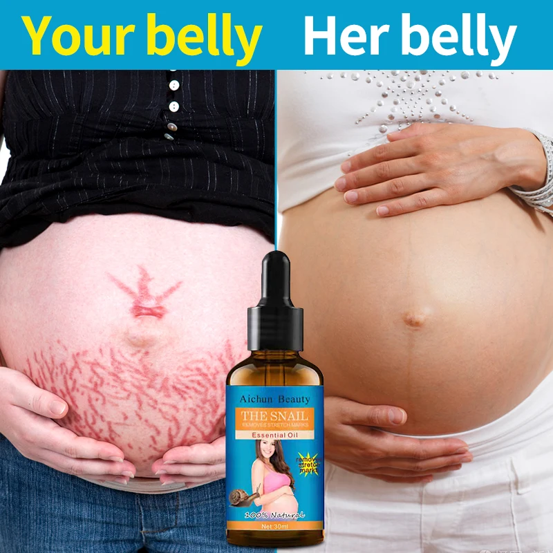 Natural Removal Pregnancy Essential Oils Prevent Stretch Marks From Growing Postpartum Repair Fade Abdominal Scars Firm Skin