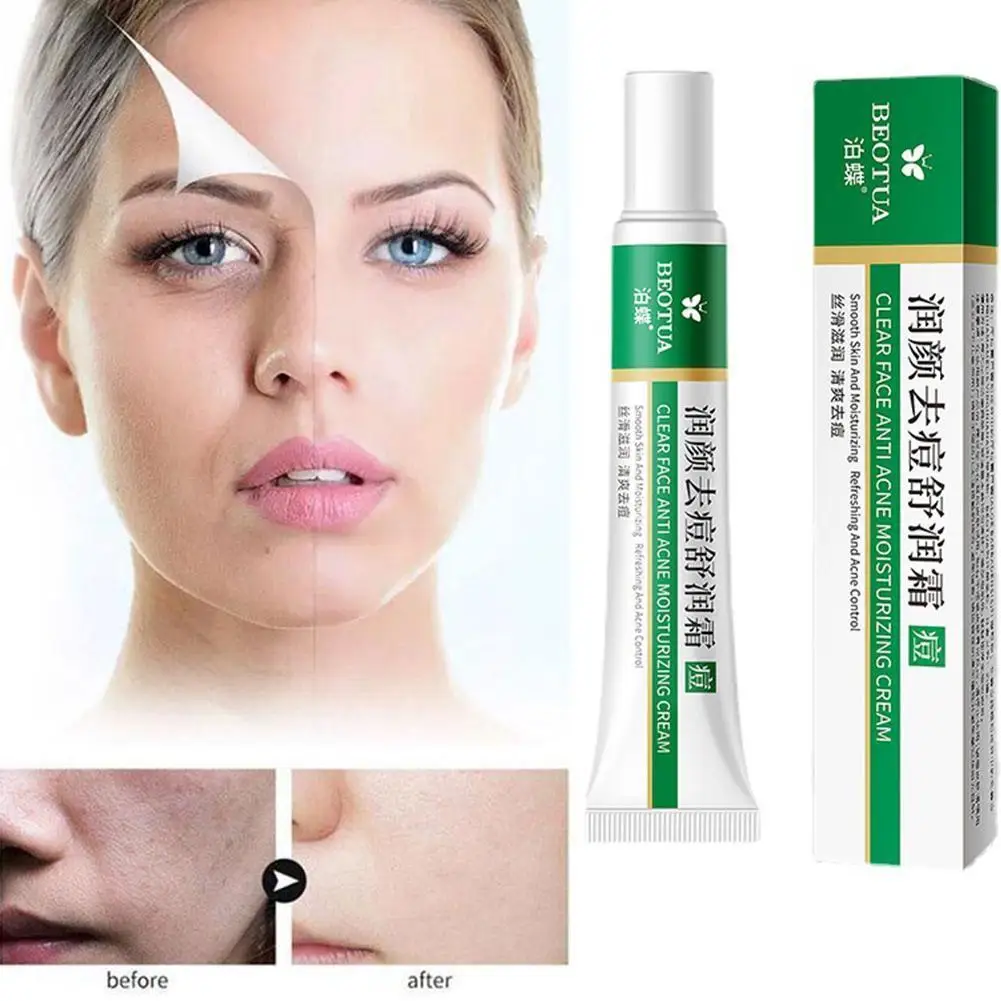 Herbal Anti Effective Acne Removal Cream Effective Acne Removal Cream Oil Control Whitening Moisturizing Face Gel Skin