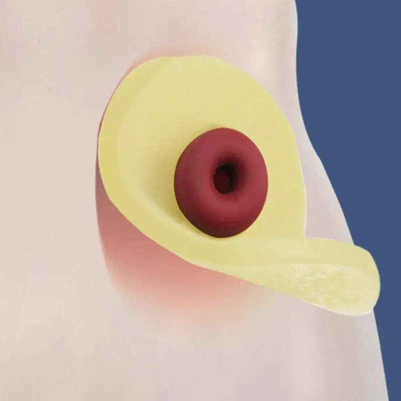 Hot 10Pcs Anti-Leakage Ring For Colostomy Bag Ostomy Paste Ring Baseplates Stoma Care Products To Protect Skin