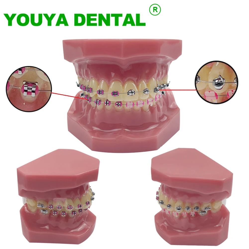 

New Orthodontic Dental Model With Metal Ceramic Bracket Ball Shaped Self Ligating Typodont Teeth Model For Patient Communication