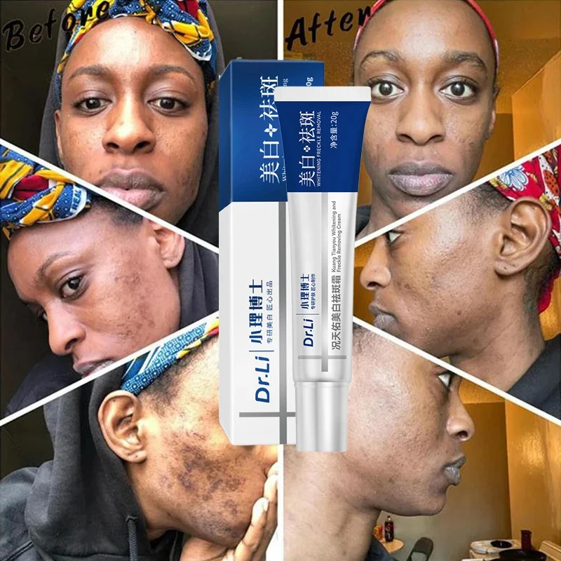 Effective Whitening Freckle Cream  Fade Pigmentation Moisturize Brighten Face Remove Melasma Dark Spots Korean Skin Care Product