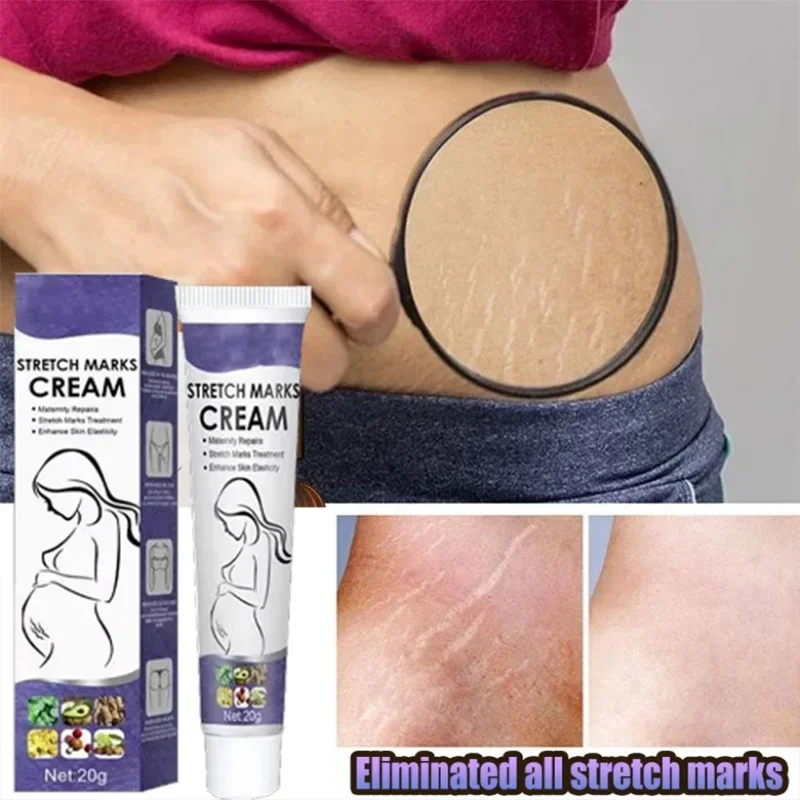 Eliminate Red White Old Stretch Marks Cream For Pregnancy Postpartum Skin Care Gel