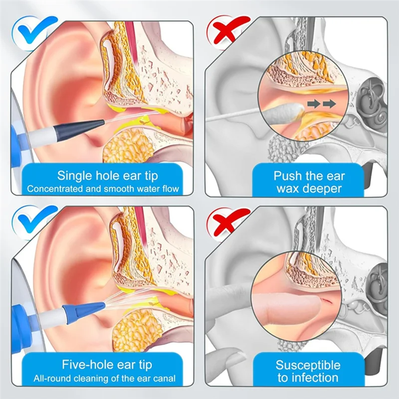 

Earwax Removal Tool Kit Manual Ear Irrigation Flushing System Ear Cleaning Tools Clean Ear Built Up Wax