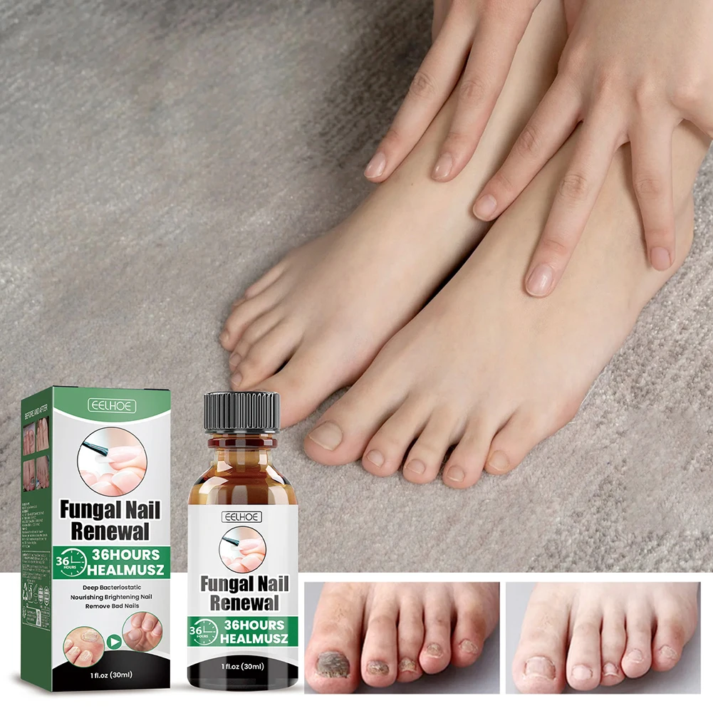 

30 мл средства для лечения ногтей на ногах, сверхпрочная ручка для обновления грибка ногтей на ногах, быстродействующая ручка для ремонта ногтей для поврежденных обесцвеченных ногтей