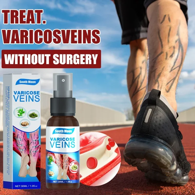 Spray for varicose veins Effective varicose vein relief cream to relieve Leg vasculitis phlebitis spider pain swelling treatment