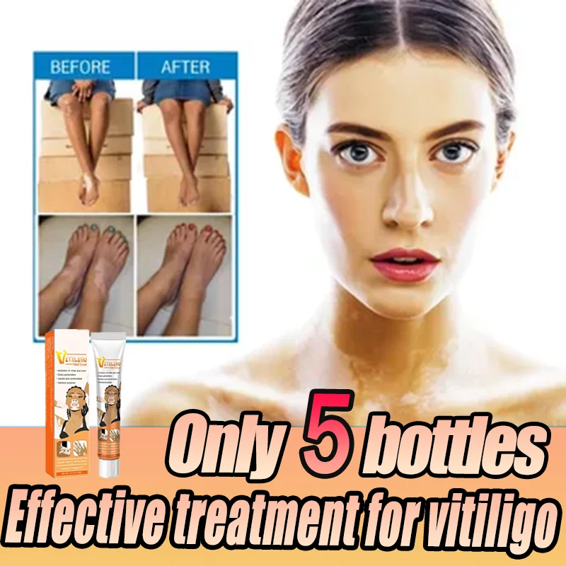 Effective vitiligo repair cream and white spot lightening product