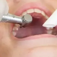 

100 шт./пакет, одноразовые всасывающие наконечники высокого объема, вентилируемые наконечники для стоматологической эвакуации, стоматологические инструменты