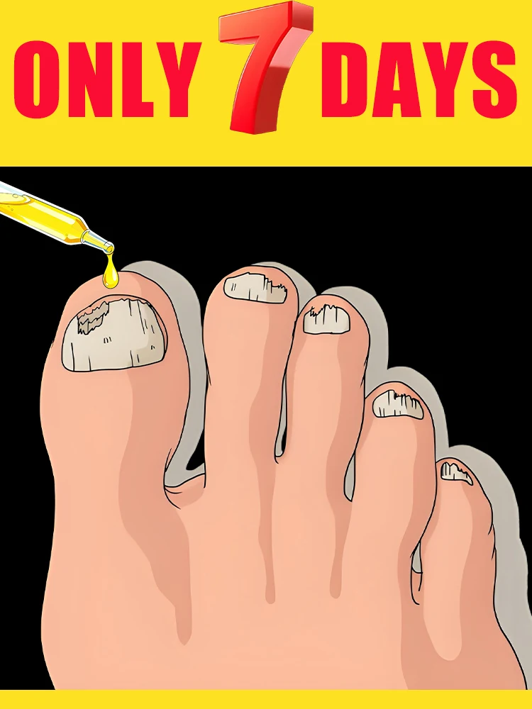 Elimina rápidamente los hongos y restaura las uñas saludables.