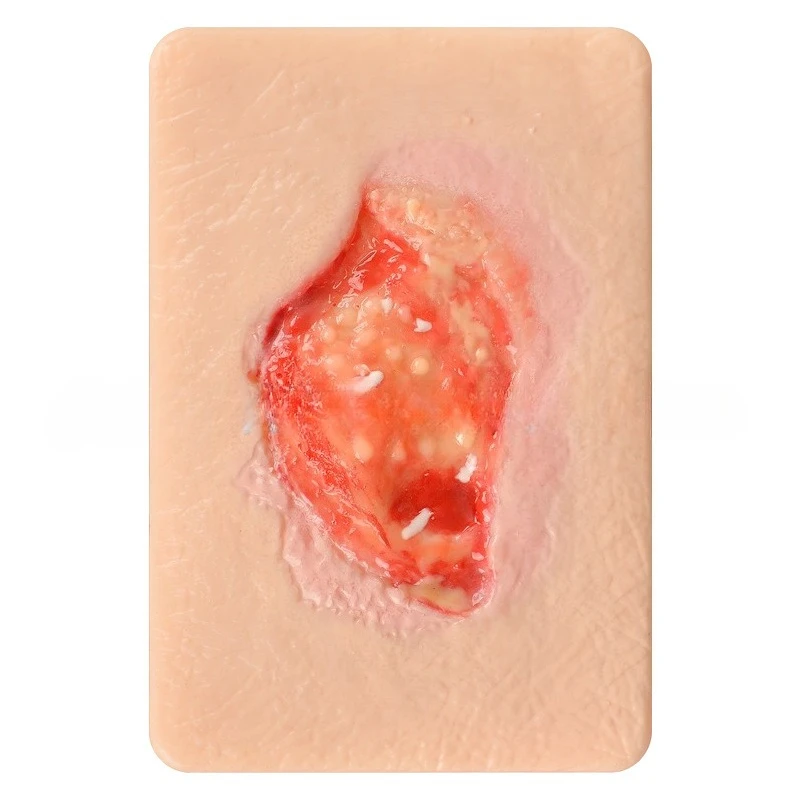 

Medical teaching Skin wound growth different granulation models Skin granulation wound models