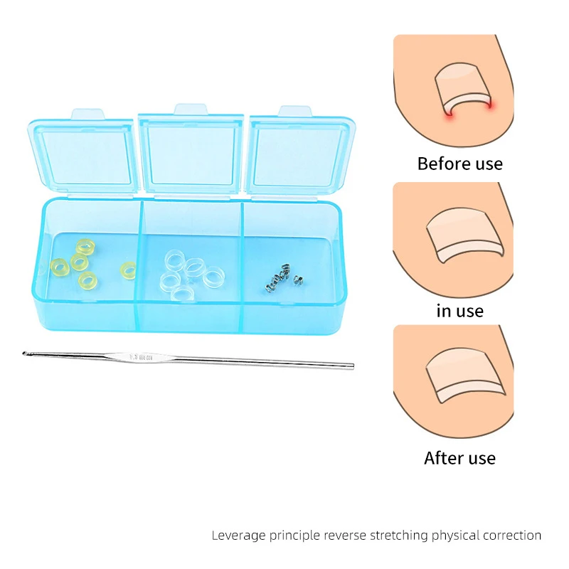 Corretor de unhas dos pés, pedicure, recuperação, tratamento de unhas dos pés, profissional, adesivo de correção de pés, ferramenta de cuidados