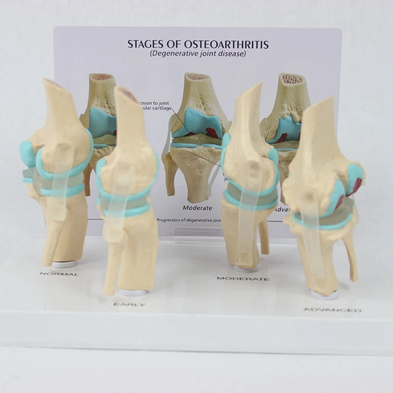 Top-Knee Kit Osteoarthritis Anatomy Model With Educational Key Card 4 Stage Knee Model Orthopedic Teaching Aids