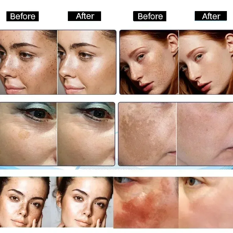 Niacinamide Donkere Vlekken Verwijderaar Serum Sproet Whitening Vocht Krachtige Verwijdering Black Dot Melasma Chloasma Gezicht Huidverzorgingscrème