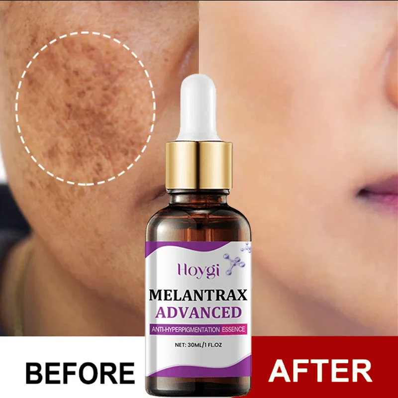 

Dark Spots Remover Whitening Serum Face Freckle Melanin Correcting Anti Pigmentation Brighten Beauty Korean Day Night Skin Care