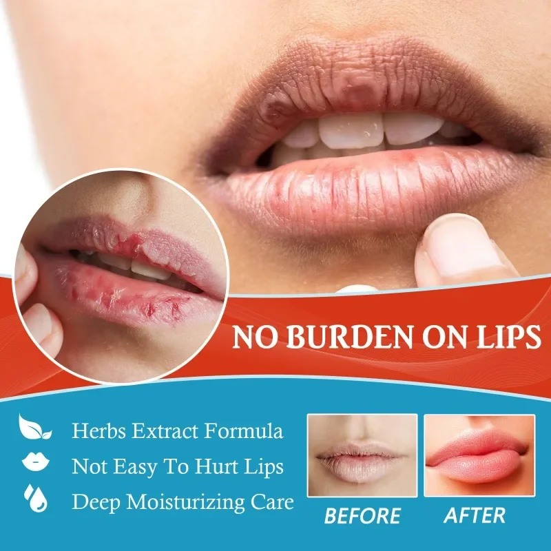 Cold Sores Lip Cheilitis Treatment Cream Herpes Antibacterials Ointment Chapped exfoliating fade Lip line moisturizing care balm