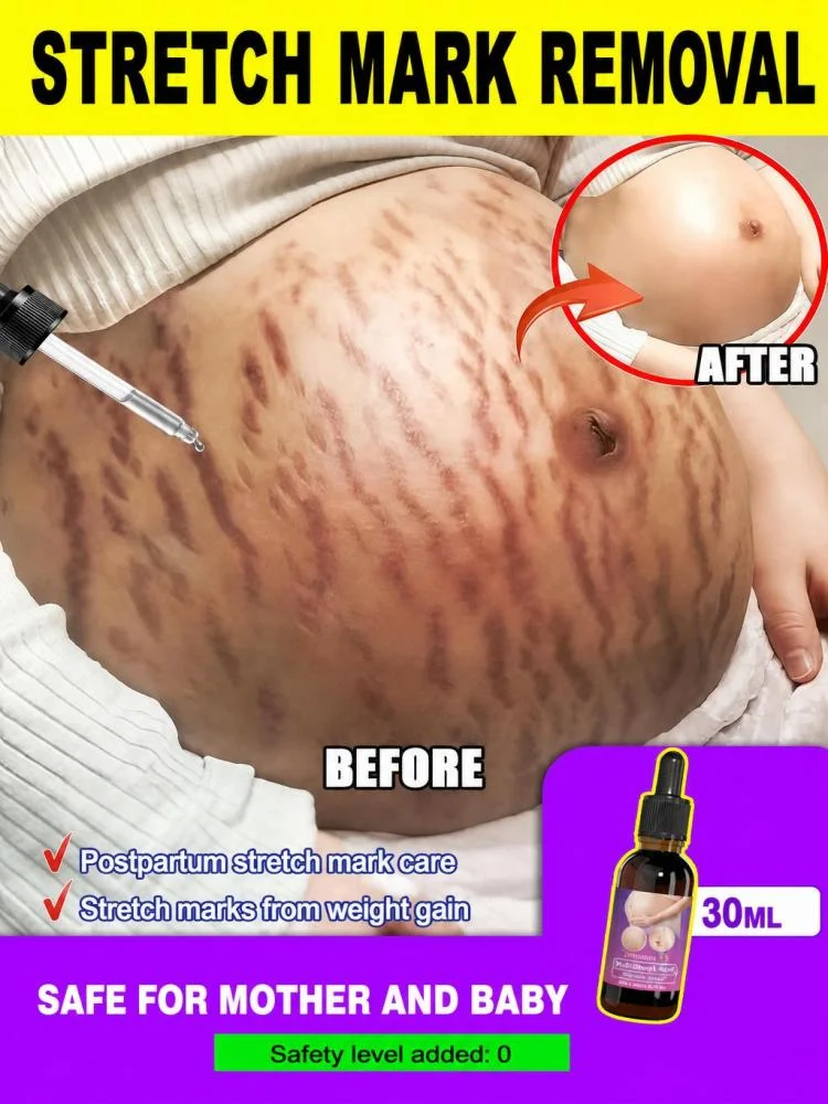 Repair oil for pregnancy stretch marks; anti-wrinkle, firming, nourishing, and skin-smoothing; enhances elasticity and fades stretch marks.