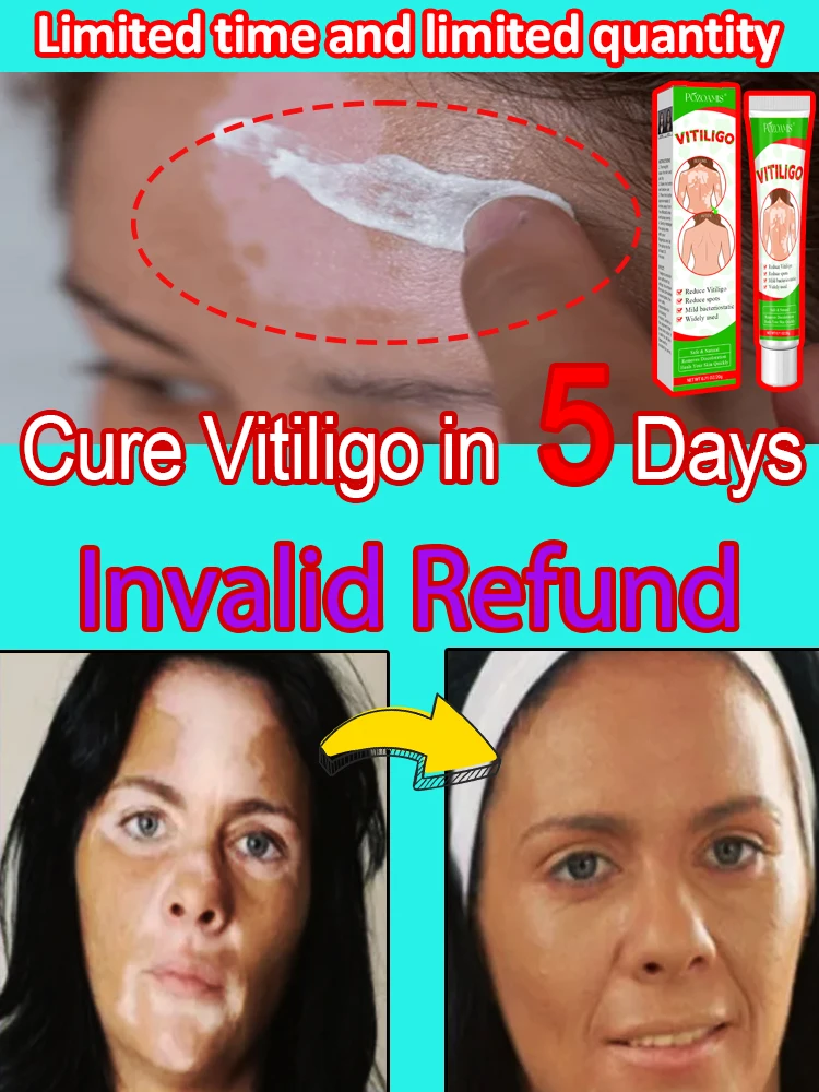 vitiligo magic tool