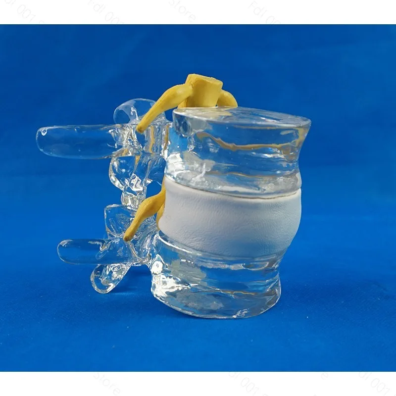 1.5X Human Lumbar Spine Skeleton Anatomical Model Degenerative Lumbar Disc Herniation Demonstration Model Spinal Assist Tool