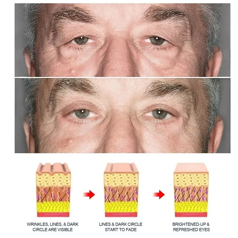 Creme removedor de grânulos de gordura para os olhos, creme anti-inchaço para rugas, clareia olheiras, desbotamento de linhas finas, hidratante, cuidados com os olhos