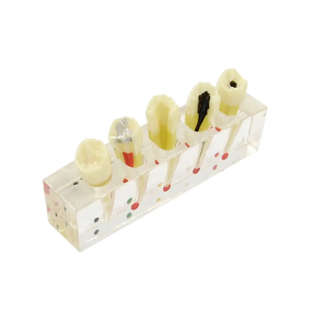 Dentist Patient Communication Pathology Model Pulp Disease Restoration Model with Removable Bad Tooth Structure