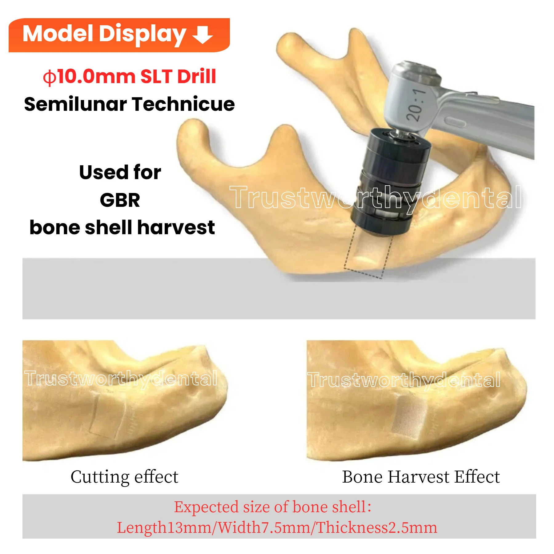 3 حجم الأسنان SLT كتل العظام الحصاد الحفر GBR تقنية Semilunar زرع العظام جامع نصف القمر الحصاد الحفر الأكمام المعدنية
