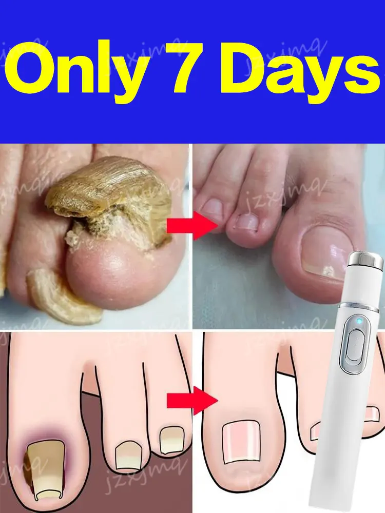 Nail Laser Device Repair Fungal Onychomycosis